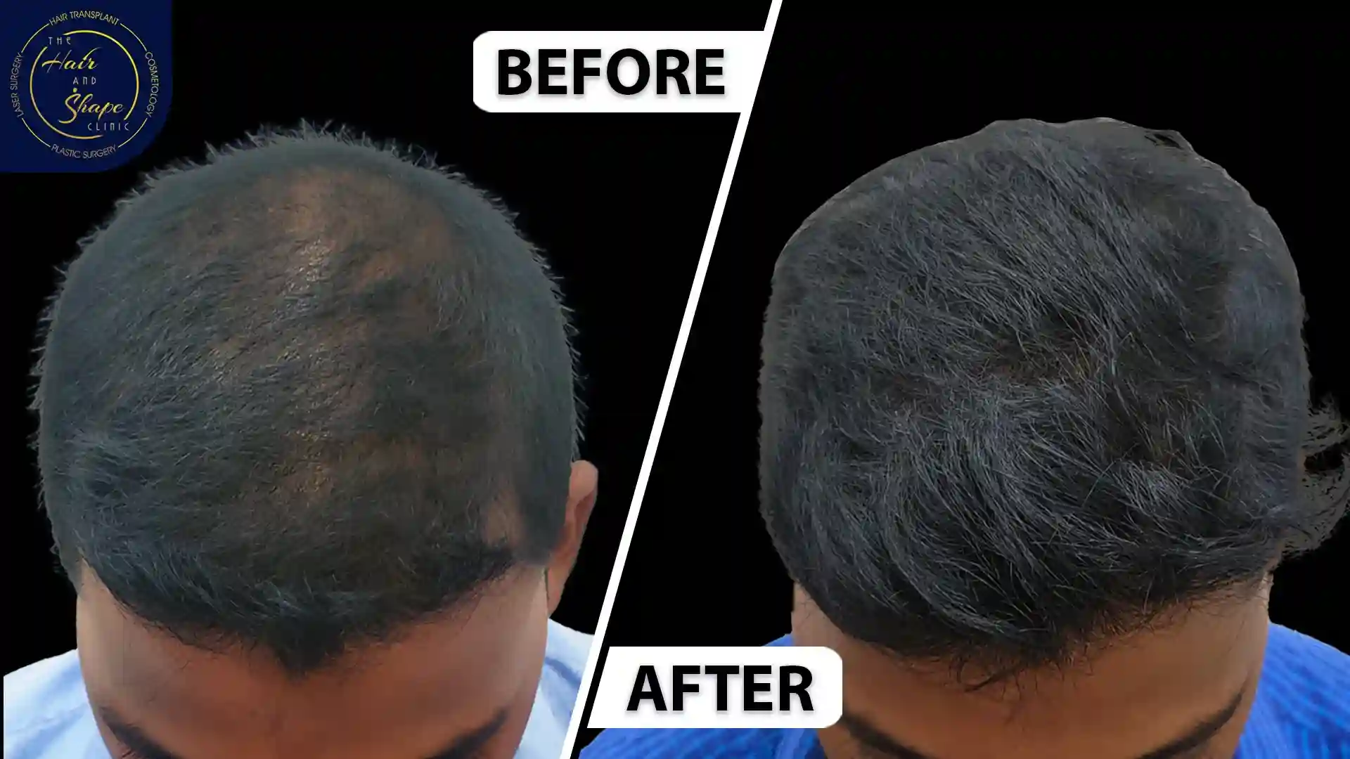 PRP Treatment result10